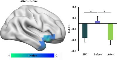 Transcutaneous Spinal Cord Direct-Current Stimulation Modulates Functional Activity and Integration in Idiopathic Restless Legs Syndrome